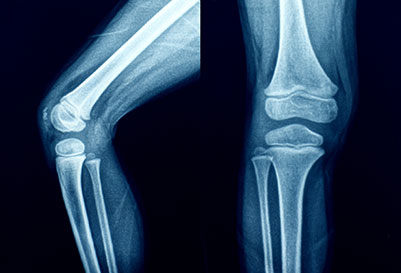 xray of knees